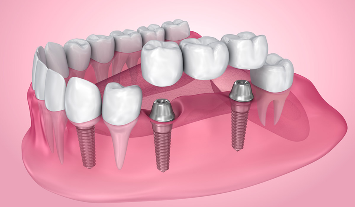 what to know about dental implants – complications and failure