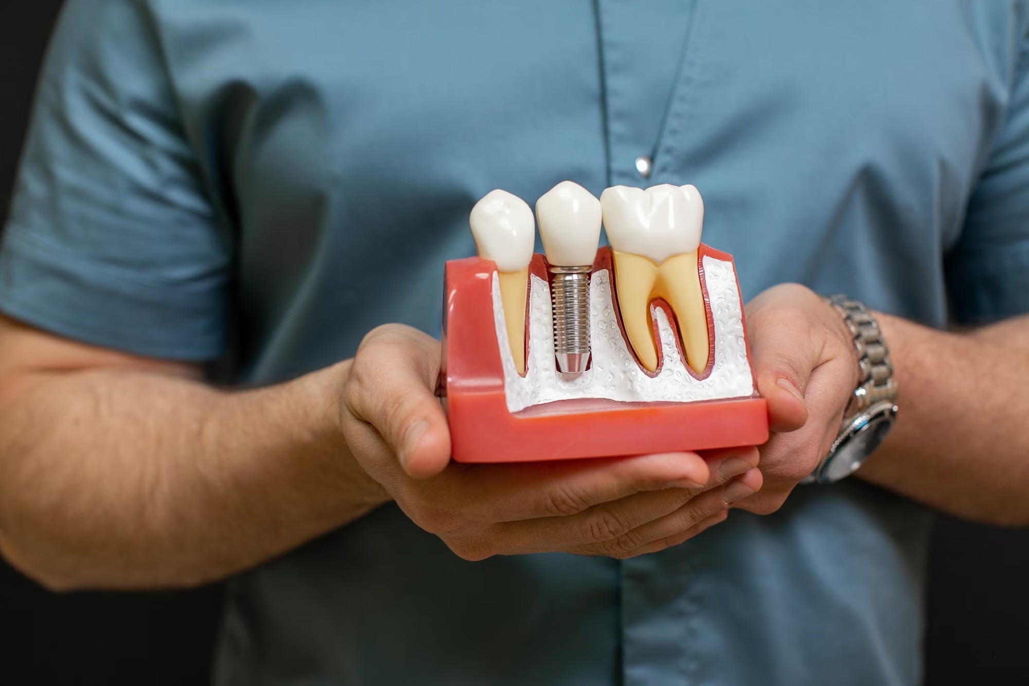 How Long Do Dental Implants Really Last? Myths vs. Facts