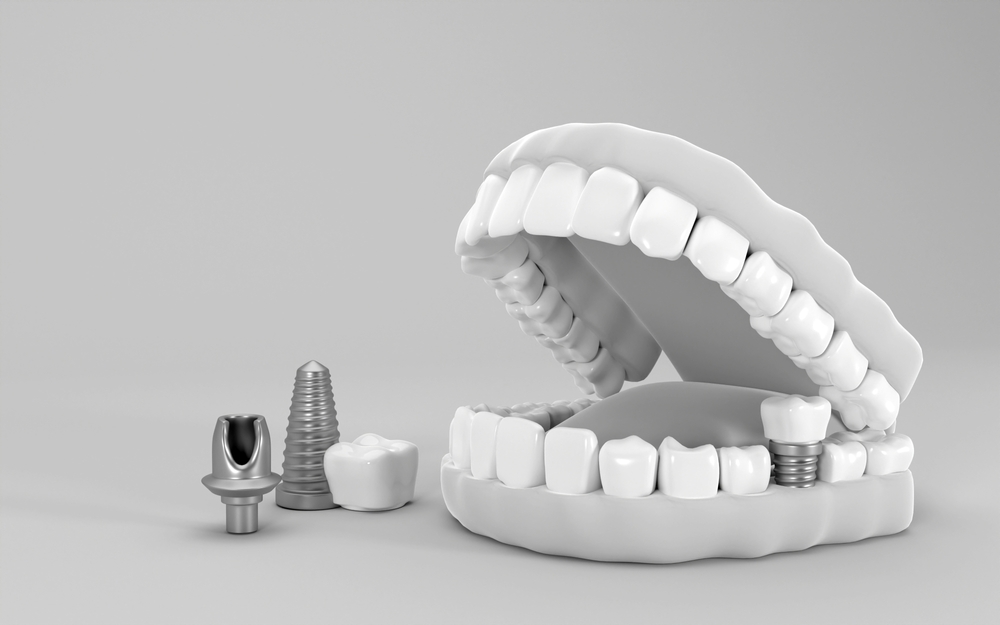 step-by-step journey: from consultation to dental implant placement