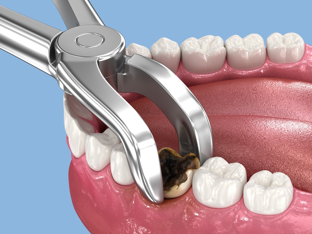 a complete guide to tooth extractions: when and why they’re needed