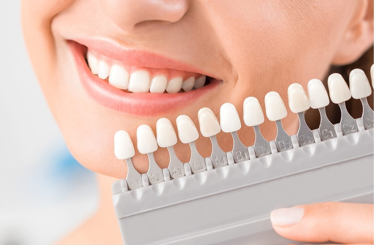 dental veneers for smile transformation